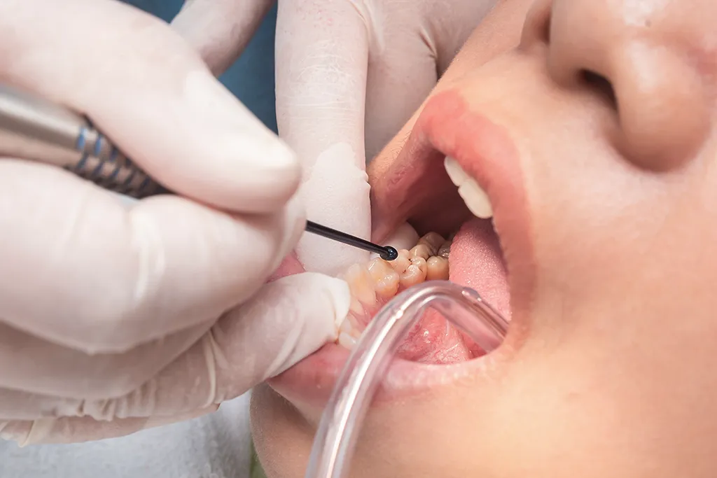 Dental implant anatomical diagram