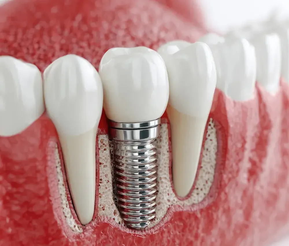 Precision dental restoration procedure